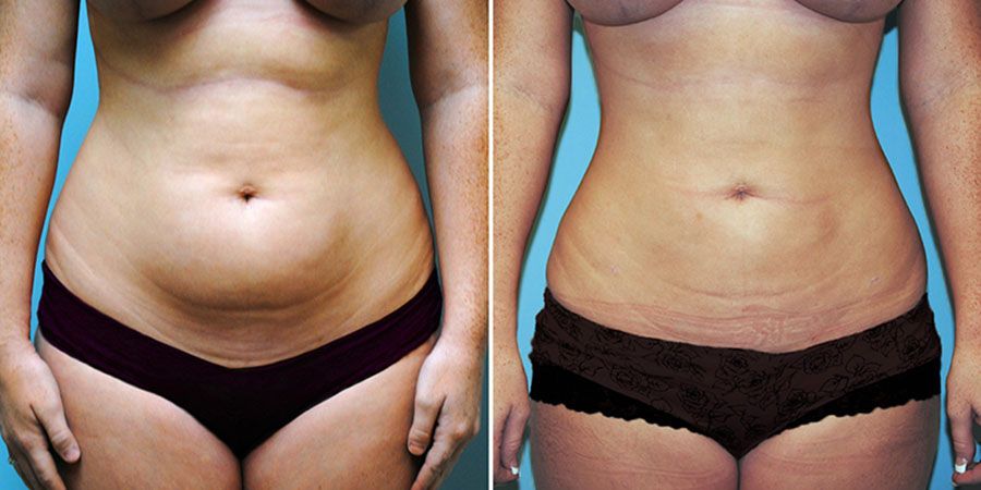 фото до&nbsp;и&nbsp;после вайзер-терапии