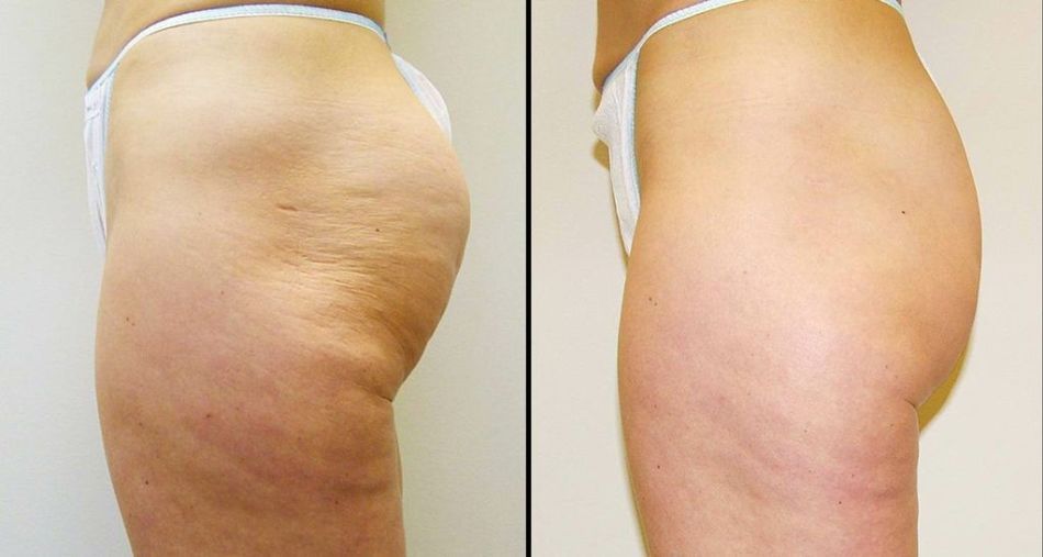 Эффект от&nbsp;Велошейп&nbsp;&mdash; курс из&nbsp;10 процедур