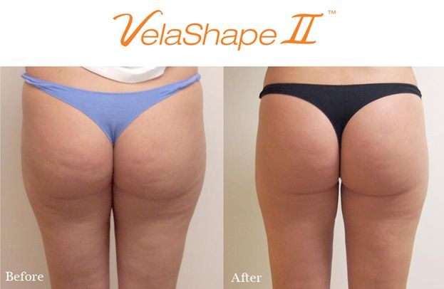 Курс Велошейп для&nbsp;ягодиц и&nbsp;бедер