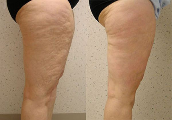 Борьба с&nbsp;апельсиновой коркой процедурами Велошейп