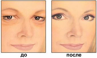 До и&nbsp;после блефоропластики