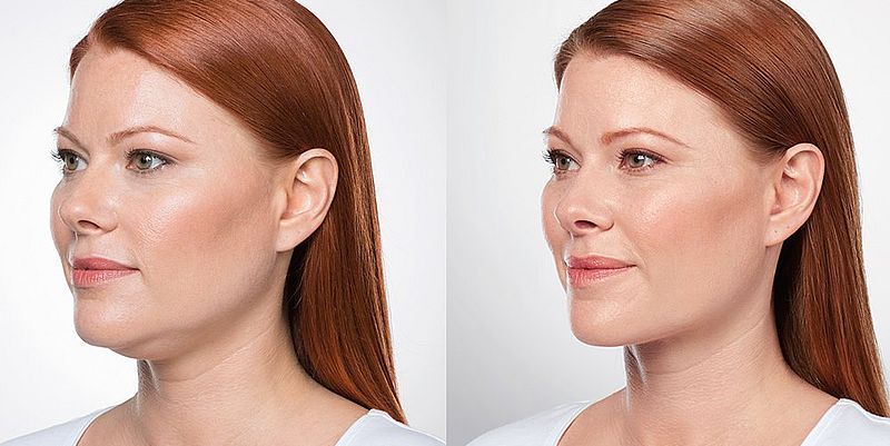 Второй подбородок лифтинг