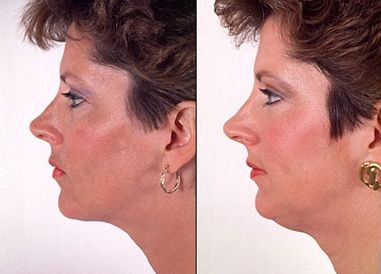 Второй подбородок липосакция