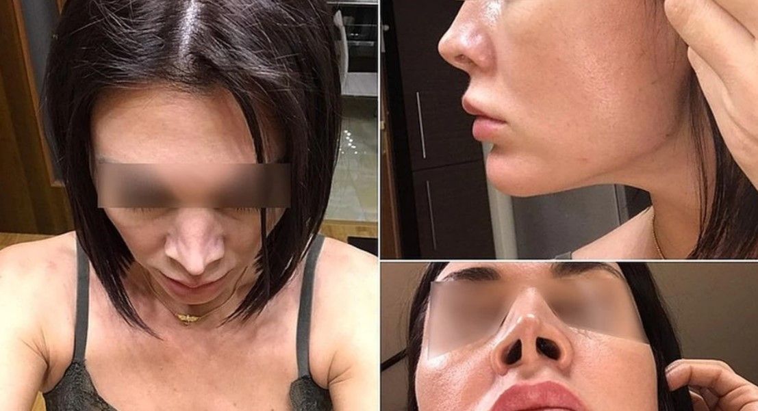 Жертва пластики