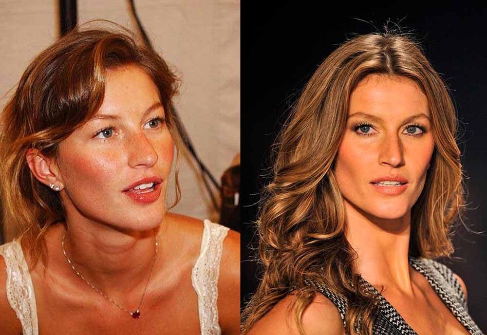 Жизель Бюндхен ринопластика